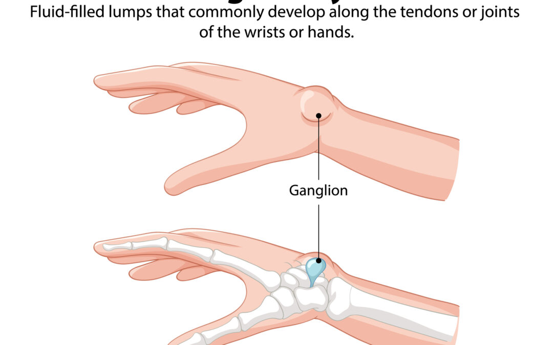 Ganglion Excision Surgery