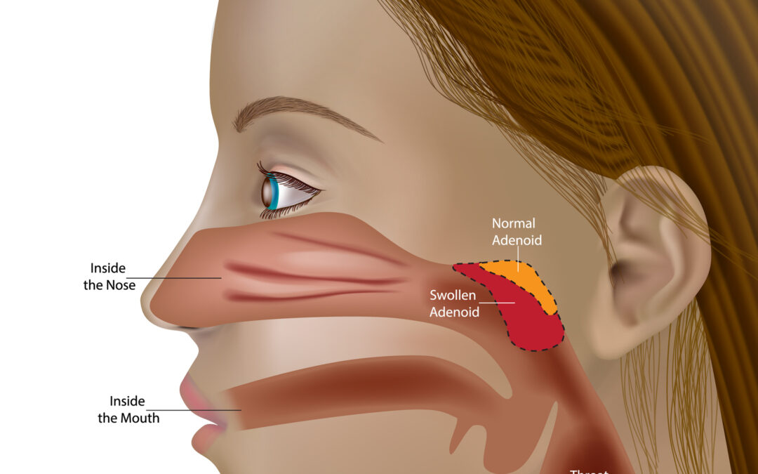 Tonsillectomy and Adenoidectomy Surgery